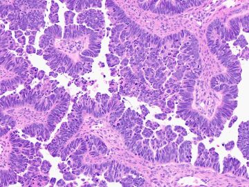 C&eacute;lulas de carcinoma seroso de alto grado