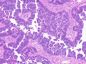 Células de carcinoma seroso de alto grado Células de carcinoma seroso de alto grado
