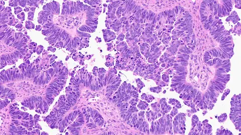 Células de carcinoma seroso de alto grado Células de carcinoma seroso de alto grado