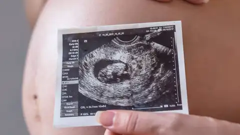 Ecografía Ecografía