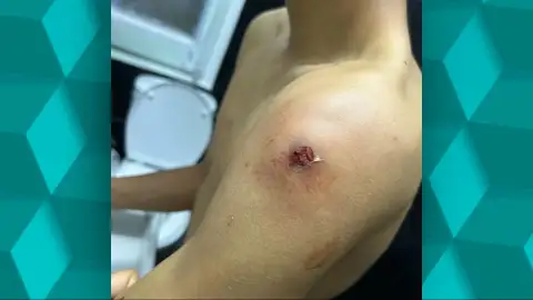 El brazo de Alen tras recibir un disparo mientras estaba en el sofá con sus amigos El brazo de Alen tras recibir un disparo mientras estaba en el sofá con sus amigos