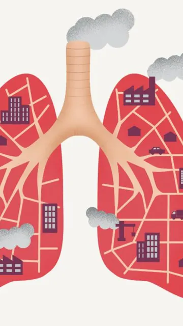 Ilustración sobre el cáncer de pulmón en personas no fumadoras