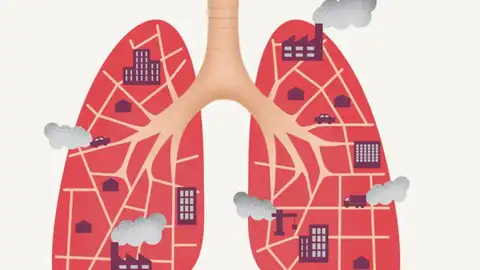 Ilustración sobre el cáncer de pulmón en personas no fumadoras Ilustración sobre el cáncer de pulmón en personas no fumadoras