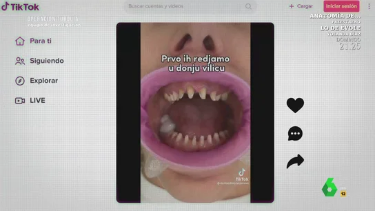 Un dentista, tajante sobre la moda de sustituir todos los dientes por coronas: "Es una salvajada" Un dentista, tajante sobre la moda de sustituir todos los dientes por coronas: "Es una salvajada"