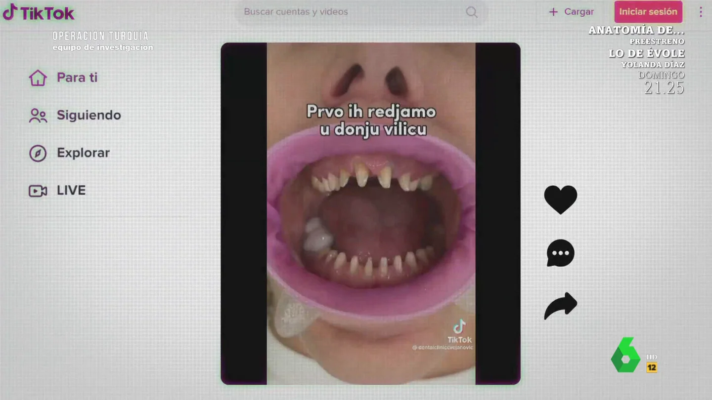 Un dentista, tajante sobre la moda de sustituir todos los dientes por coronas: "Es una salvajada" Un dentista, tajante sobre la moda de sustituir todos los dientes por coronas: "Es una salvajada"