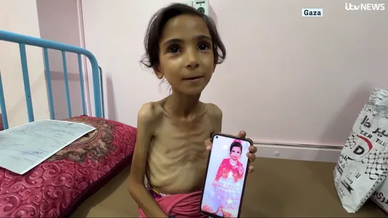 Amal, el rostro de la desnutrición en Gaza: "Quiero volver a estar como estaba". Amal, el rostro de la desnutrición en Gaza: "Quiero volver a estar como estaba".