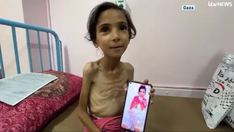 Amal, el rostro de la desnutrición en Gaza: "Quiero volver a estar como estaba". Amal, el rostro de la desnutrición en Gaza: "Quiero volver a estar como estaba".