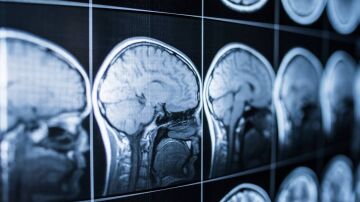 Cerebro