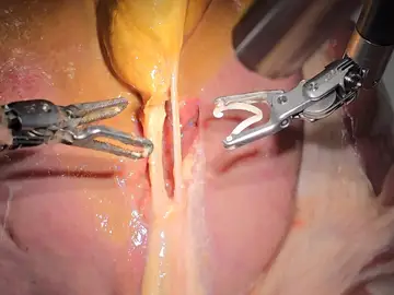 Imagen del robot SRT-H mientras realiza parte de una extirpación de vesícula Imagen del robot SRT-H mientras realiza parte de una extirpación de vesícula