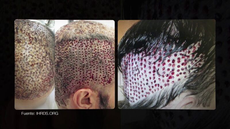 Pelo de muñeca, cicatrices irreversibles y graves infecciones: las consecuencias de la mala praxis en las cirugías de implante capilar