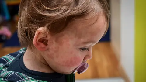 Niño con sarampión Niño con sarampión