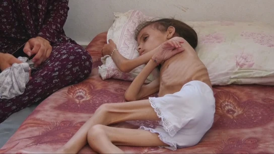 Un niño gazatí, desnutrido Un niño gazatí, desnutrido