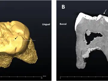 Imagen del molar y la caries de un neandertal que vivió en la cueva de El Sidrón hace unos 49.000 años Imagen del molar y la caries de un neandertal que vivió en la cueva de El Sidrón hace unos 49.000 años