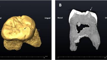 Imagen del molar y la caries de un neandertal que vivió en la cueva de El Sidrón hace unos 49.000 años