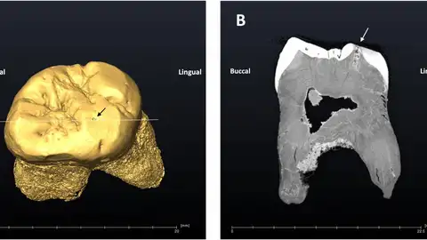 Imagen del molar y la caries de un neandertal que vivió en la cueva de El Sidrón hace unos 49.000 años Imagen del molar y la caries de un neandertal que vivió en la cueva de El Sidrón hace unos 49.000 años