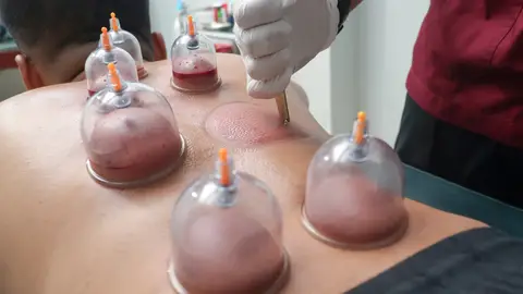 Cupping Cupping