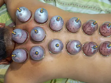 Cupping Cupping