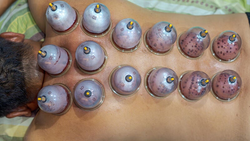 Qué es el cupping, la práctica para aliviar el dolor de la que alerta Sanidad