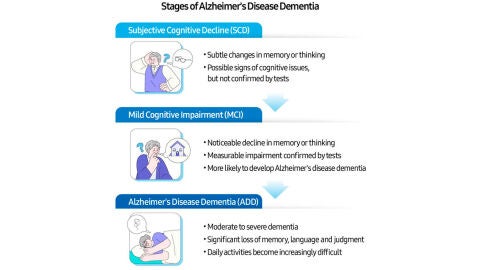 Las diferentes fases del Alzheimer