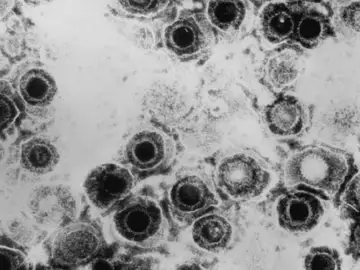 Virus del herpes simple Virus del herpes simple