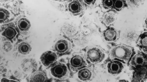 Virus del herpes simple Virus del herpes simple
