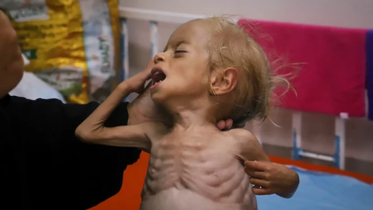 Una pequeña de dos años afectada por desnutrición en el Hospital de Nasser, Gaza. Una pequeña de dos años afectada por desnutrición en el Hospital de Nasser, Gaza.