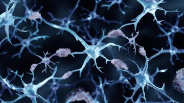 Alzheimer