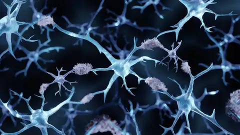 Alzheimer Alzheimer