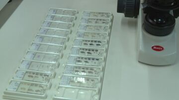 Avance cura alzheimer 