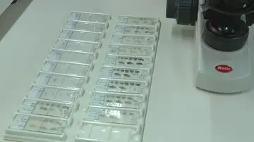 Avance cura alzheimer Avance cura alzheimer