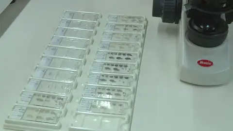 Avance cura alzheimer Avance cura alzheimer