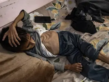 Desnutrición Desnutrición