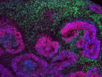 Organoide cortical humano de 8 semanas con estructuras en roseta (rosa y azul) rodeadas de neuronas (verde) Organoide cortical humano de 8 semanas con estructuras en roseta (rosa y azul) rodeadas de neuronas (verde)