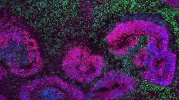 Organoide cortical humano de 8 semanas con estructuras en roseta (rosa y azul) rodeadas de neuronas (verde) Organoide cortical humano de 8 semanas con estructuras en roseta (rosa y azul) rodeadas de neuronas (verde)