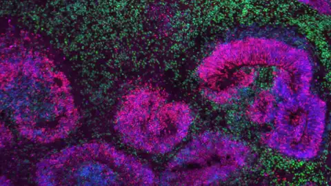 Organoide cortical humano de 8 semanas con estructuras en roseta (rosa y azul) rodeadas de neuronas (verde) Organoide cortical humano de 8 semanas con estructuras en roseta (rosa y azul) rodeadas de neuronas (verde)