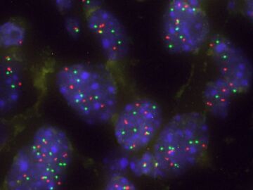 C&eacute;lulas tumorales pulmonares