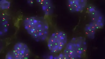 Células tumorales pulmonares Células tumorales pulmonares