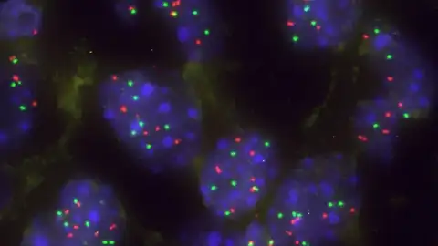 Células tumorales pulmonares Células tumorales pulmonares