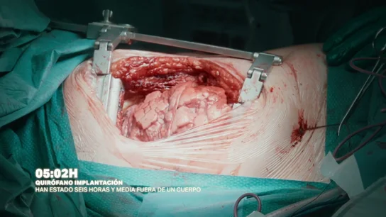 Las cámaras de Salvados asisten al "momento mágico" en el que un pulmón trasplantado se hincha por primera vez en el cuerpo del paciente Las cámaras de Salvados asisten al "momento mágico" en el que un pulmón trasplantado se hincha por primera vez en el cuerpo del paciente