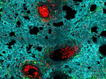 Neutr&oacute;filos en el pulm&oacute;n