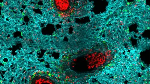 Neutrófilos en el pulmón Neutrófilos en el pulmón