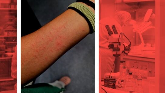 S&iacute;ntomas de algunos trabajadores de la planta cero del Hospital Universitario de Toledo.