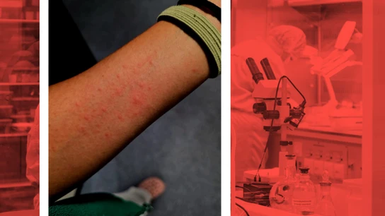 Síntomas de algunos trabajadores de la planta cero del Hospital Universitario de Toledo. Síntomas de algunos trabajadores de la planta cero del Hospital Universitario de Toledo.