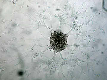 Célula de glioblastoma Célula de glioblastoma