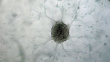 Célula de glioblastoma Célula de glioblastoma