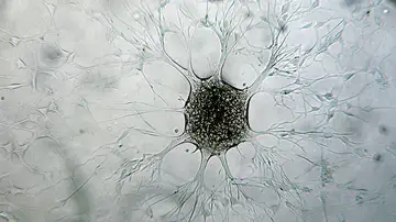 Célula de glioblastoma Célula de glioblastoma