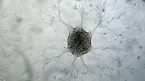 Célula de glioblastoma Célula de glioblastoma