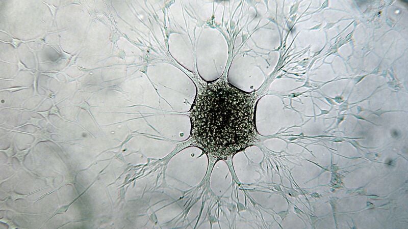Descubren cómo los tumores de glioblastoma evaden la quimioterapia