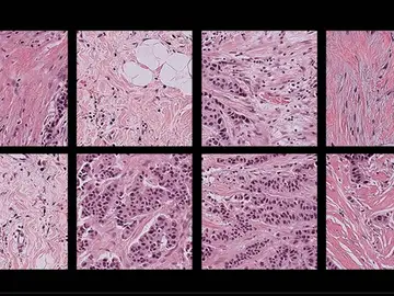Imágenes patológicas de muestras de tejido humano Imágenes patológicas de muestras de tejido humano