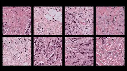 Imágenes patológicas de muestras de tejido humano Imágenes patológicas de muestras de tejido humano